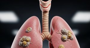 Stage Four Lung Cancer Remission: What Patients Should Know Lung Cancer