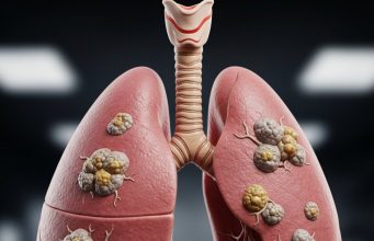 Stage Four Lung Cancer Remission: What Patients Should Know Lung Cancer