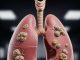 Stage Four Lung Cancer Remission: What Patients Should Know Lung Cancer